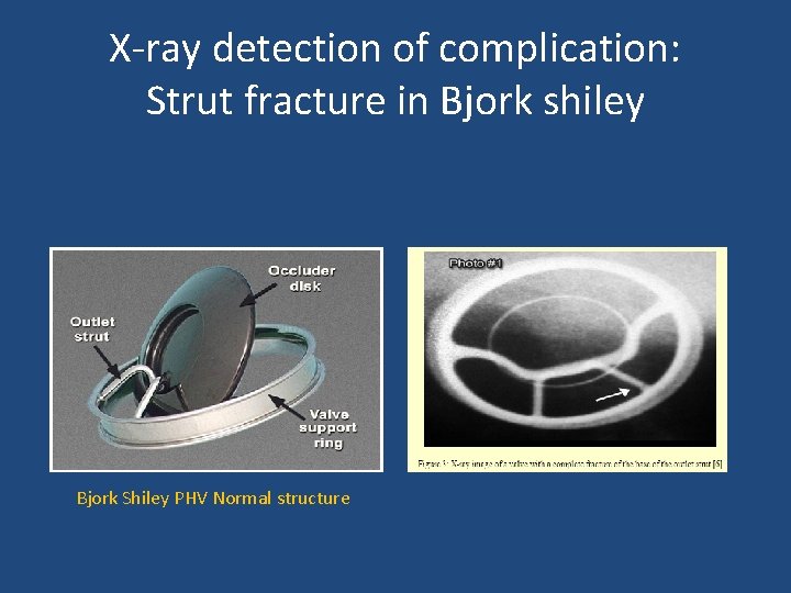 X-ray detection of complication: Strut fracture in Bjork shiley Bjork Shiley PHV Normal structure