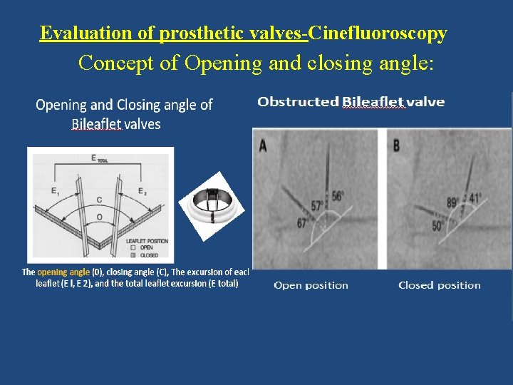 Evaluation of prosthetic valves-Cinefluoroscopy Concept of Opening and closing angle: Opening angle Medronic hall