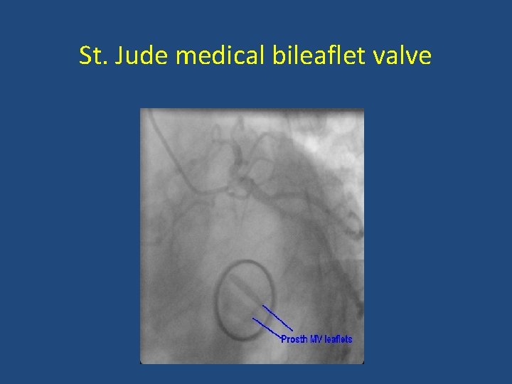 St. Jude medical bileaflet valve 