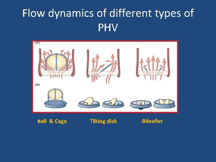Flow dynamics of different types of PHV Ball & Cage Tilting disk Bileaflet 