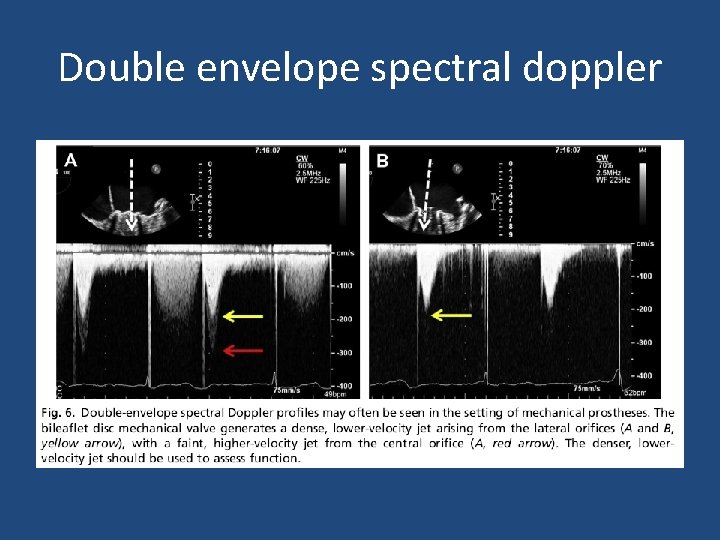 Double envelope spectral doppler 