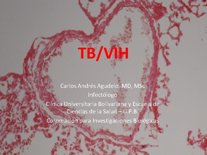 TB/VIH Carlos Andrés Agudelo. MD, MSc Infectólogo Clínica Universitaria Bolivariana y Escuela de Ciencias