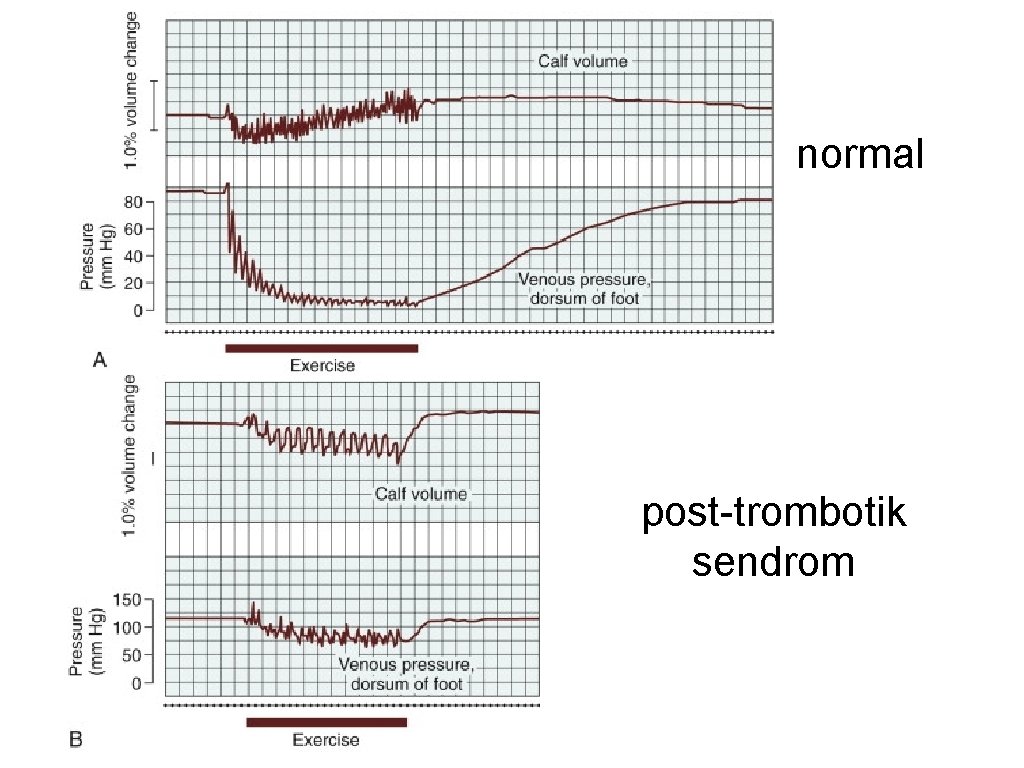 normal post-trombotik sendrom 
