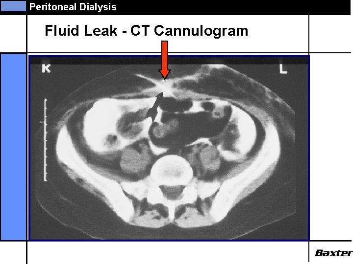 Peritoneal Dialysis Fluid Leak - CT Cannulogram 