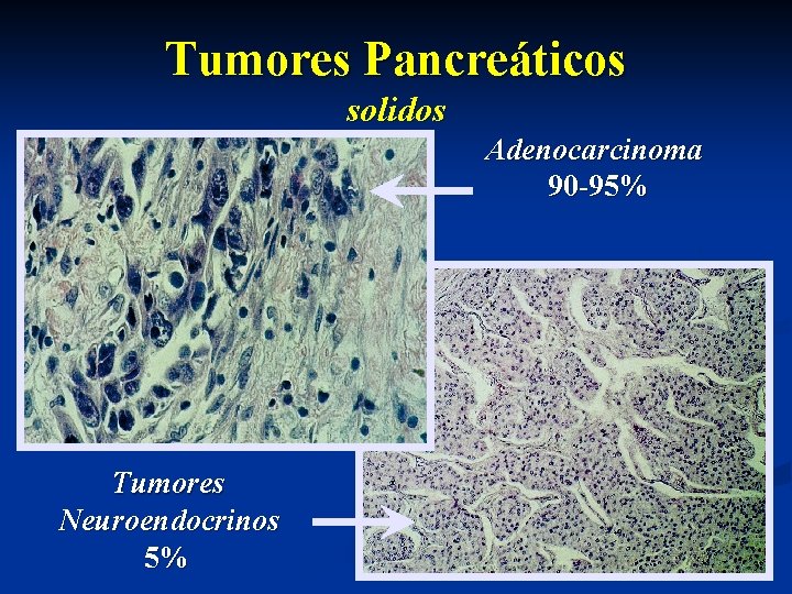 Tumores Pancreáticos solidos Adenocarcinoma 90 -95% Tumores Neuroendocrinos 5% 