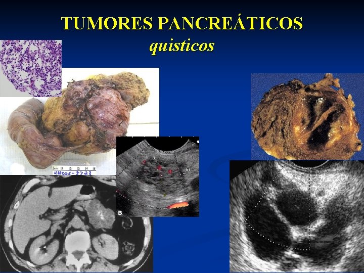 TUMORES PANCREÁTICOS quisticos 