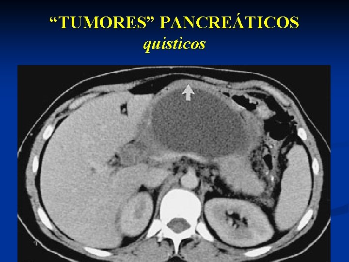 “TUMORES” PANCREÁTICOS quisticos 