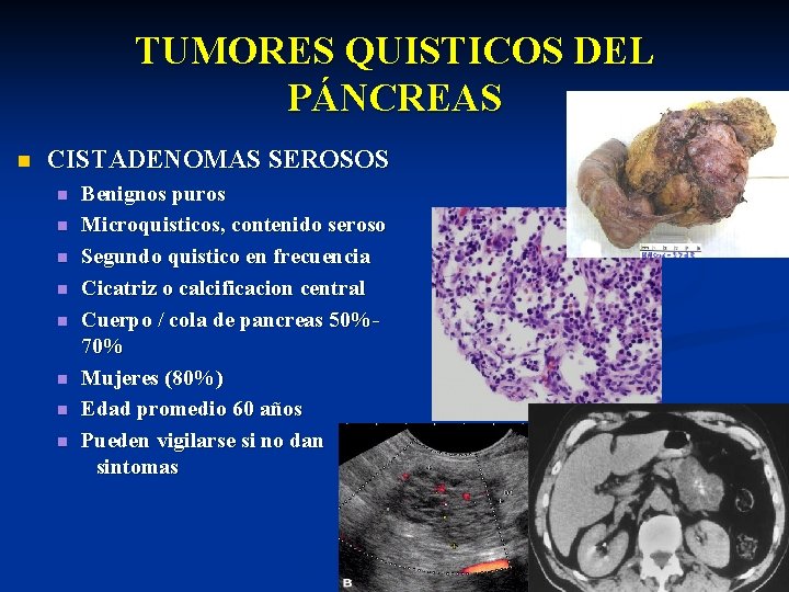 TUMORES QUISTICOS DEL PÁNCREAS n CISTADENOMAS SEROSOS n n n n Benignos puros Microquisticos,