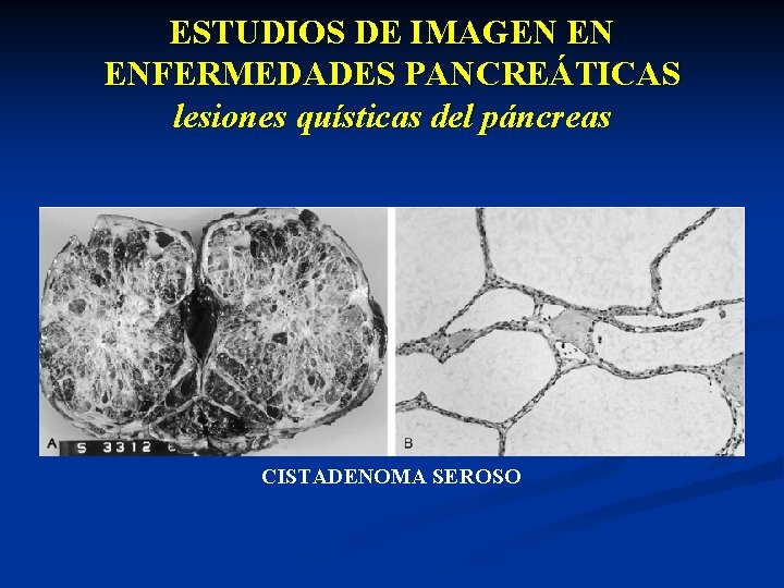 ESTUDIOS DE IMAGEN EN ENFERMEDADES PANCREÁTICAS lesiones quísticas del páncreas CISTADENOMA SEROSO 