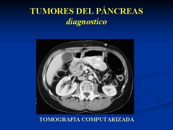 TUMORES DEL PÁNCREAS diagnostico TOMOGRAFIA COMPUTARIZADA 