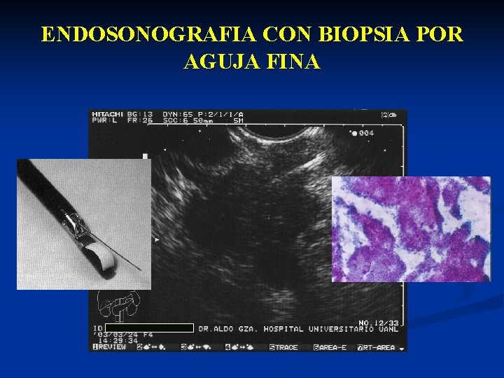 ENDOSONOGRAFIA CON BIOPSIA POR AGUJA FINA 