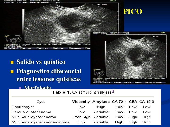 ULTRASONIDO ENDOSCÓPICO lesiones del páncreas n n Solido vs quistico Diagnostico diferencial entre lesiones