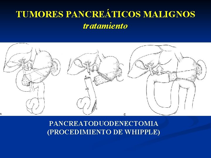 TUMORES PANCREÁTICOS MALIGNOS tratamiento PANCREATODUODENECTOMIA (PROCEDIMIENTO DE WHIPPLE) 