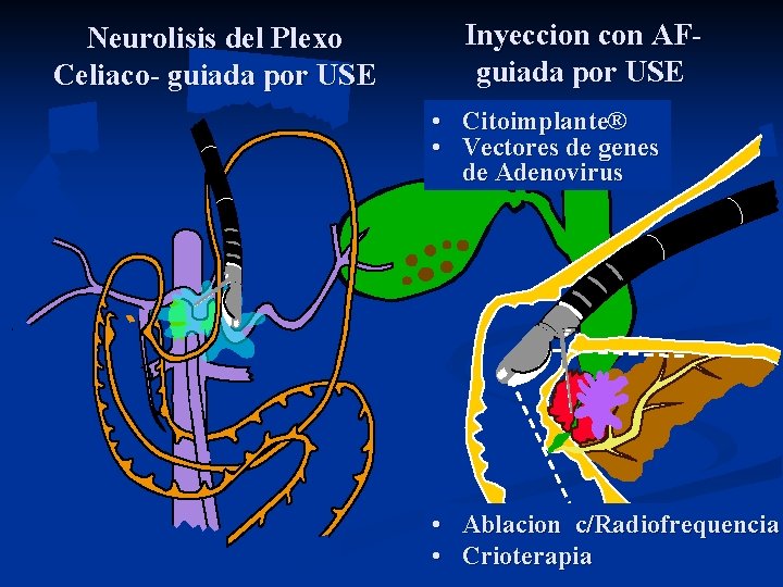 Neurolisis del Plexo Celiaco- guiada por USE Inyeccion con AFguiada por USE • Citoimplante®