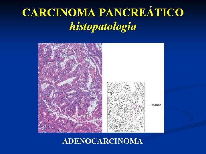 CARCINOMA PANCREÁTICO histopatologia ADENOCARCINOMA 