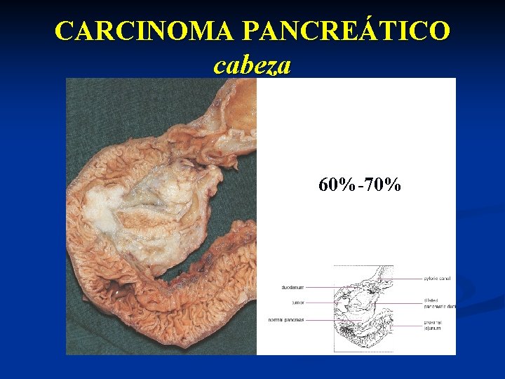 CARCINOMA PANCREÁTICO cabeza 60%-70% 