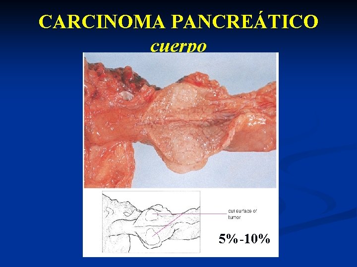 CARCINOMA PANCREÁTICO cuerpo 5%-10% 