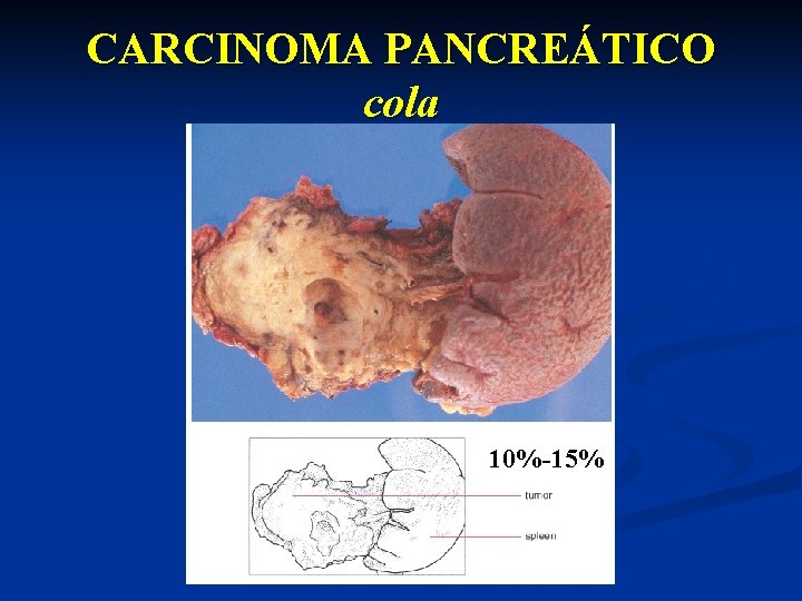 CARCINOMA PANCREÁTICO cola 10%-15% 