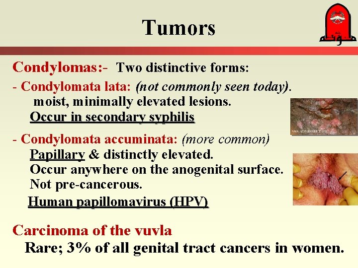 Tumors Condylomas: - Two distinctive forms: - Condylomata lata: (not commonly seen today). moist,