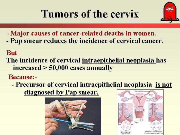 Tumors of the cervix - Major causes of cancer-related deaths in women. - Pap