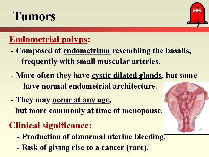 Tumors Endometrial polyps: - Composed of endometrium resembling the basalis, frequently with small muscular