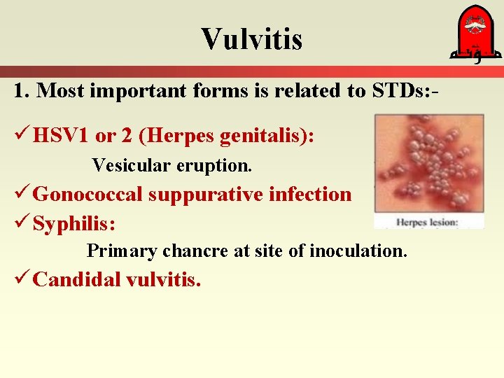 Vulvitis 1. Most important forms is related to STDs: - ü HSV 1 or