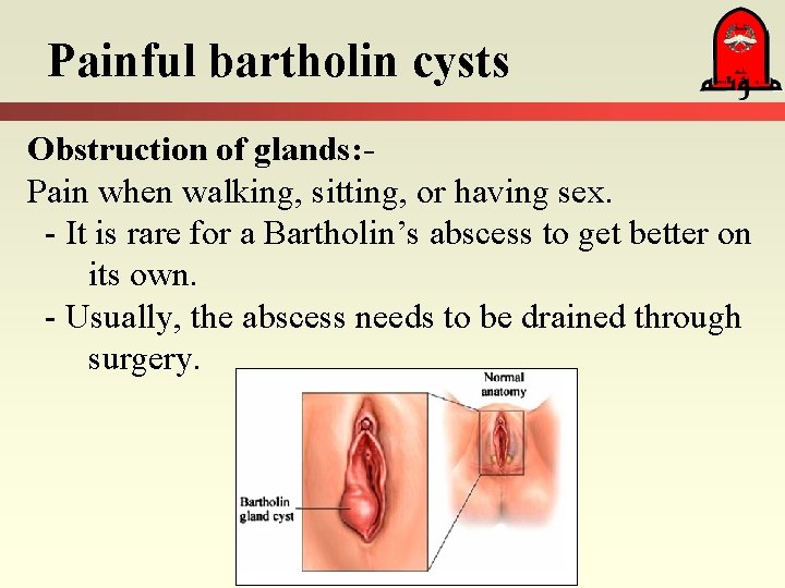 Painful bartholin cysts Obstruction of glands: Pain when walking, sitting, or having sex. -