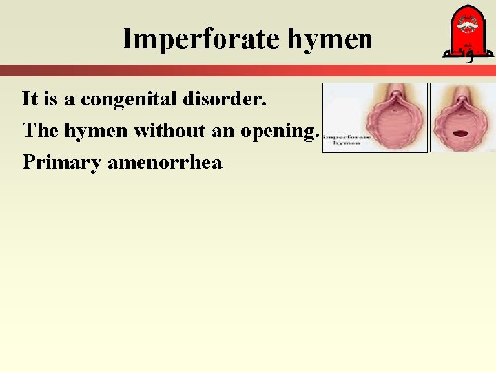 Imperforate hymen It is a congenital disorder. The hymen without an opening. Primary amenorrhea