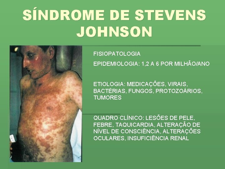 SÍNDROME DE STEVENS JOHNSON FISIOPATOLOGIA EPIDEMIOLOGIA: 1, 2 A 6 POR MILHÃO/ANO ETIOLOGIA: MEDICAÇÕES,