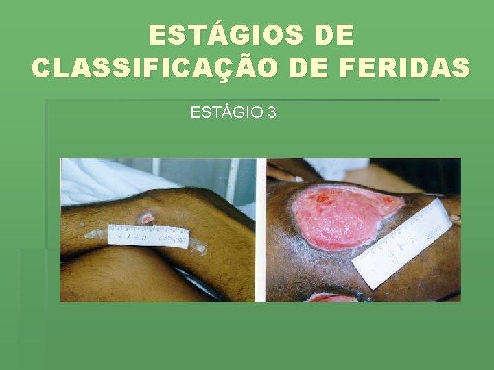 ESTÁGIOS DE CLASSIFICAÇÃO DE FERIDAS ESTÁGIO 3 