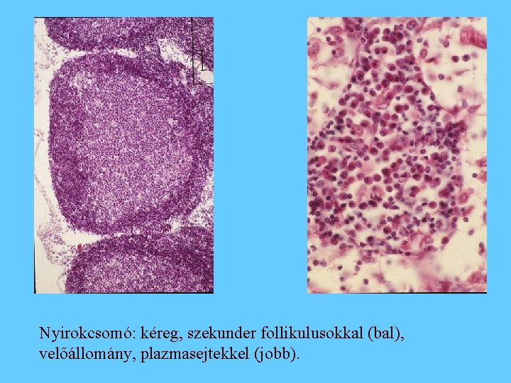 Nyirokcsomó: kéreg, szekunder follikulusokkal (bal), velőállomány, plazmasejtekkel (jobb). 