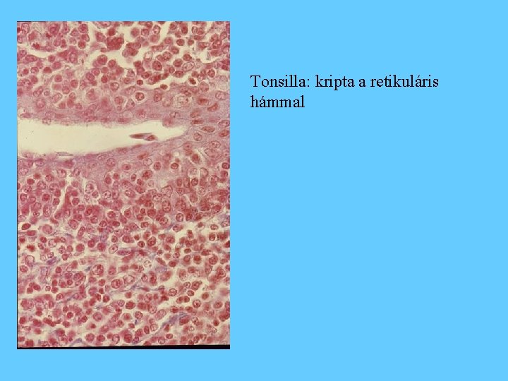 Tonsilla: kripta a retikuláris hámmal 