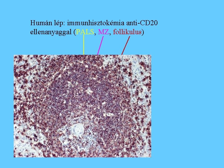 Humán lép: immunhisztokémia anti-CD 20 ellenanyaggal (PALS, MZ, follikulus) 