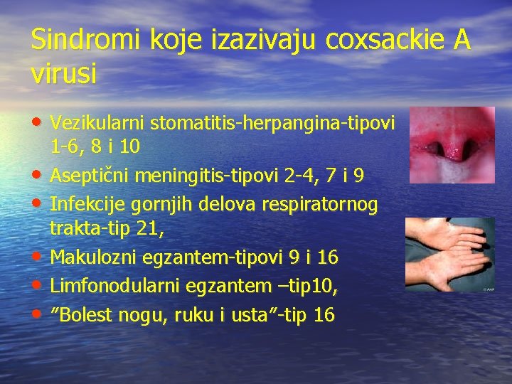 Sindromi koje izazivaju coxsackie A virusi • Vezikularni stomatitis-herpangina-tipovi • • • 1 -6,