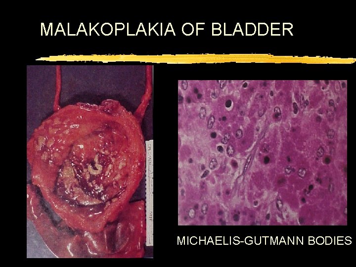 MALAKOPLAKIA OF BLADDER MICHAELIS-GUTMANN BODIES 
