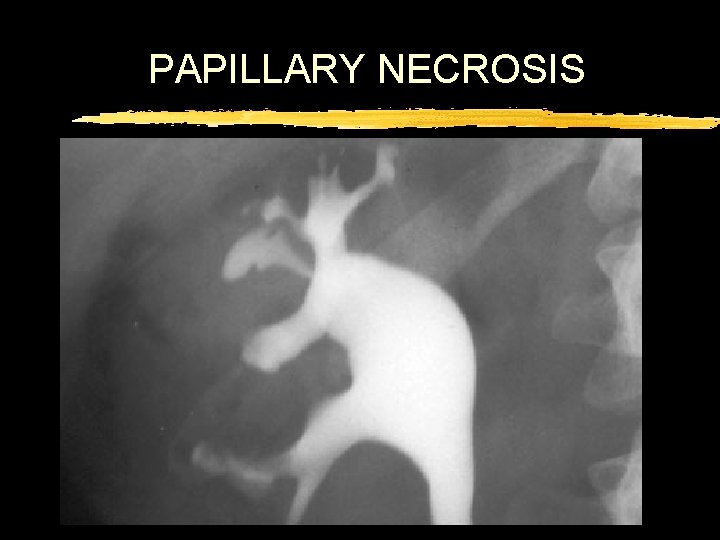 PAPILLARY NECROSIS 