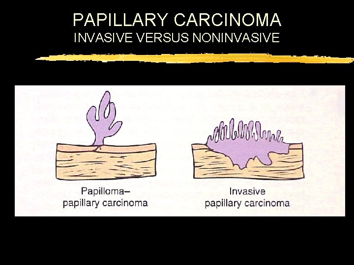 PAPILLARY CARCINOMA INVASIVE VERSUS NONINVASIVE 