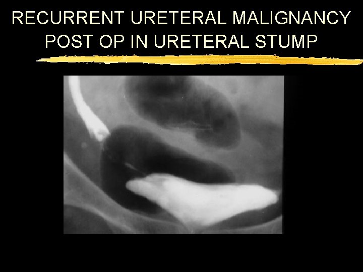 RECURRENT URETERAL MALIGNANCY POST OP IN URETERAL STUMP 