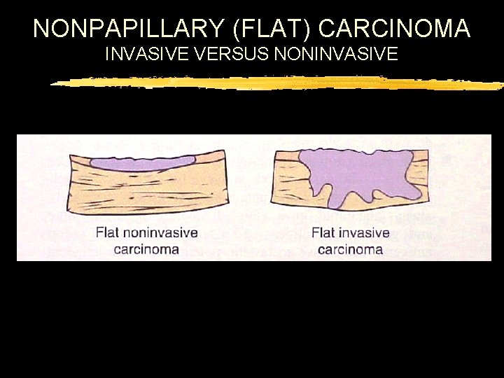 NONPAPILLARY (FLAT) CARCINOMA INVASIVE VERSUS NONINVASIVE 
