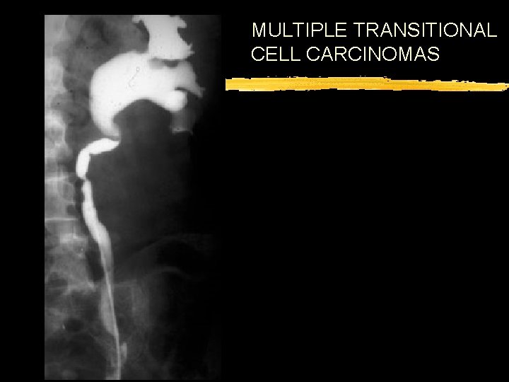 MULTIPLE TRANSITIONAL CELL CARCINOMAS 