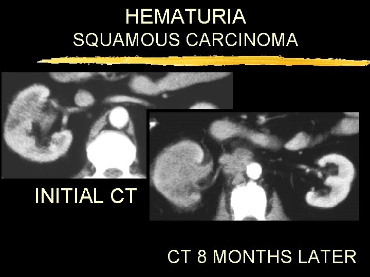 HEMATURIA SQUAMOUS CARCINOMA INITIAL CT CT 8 MONTHS LATER 