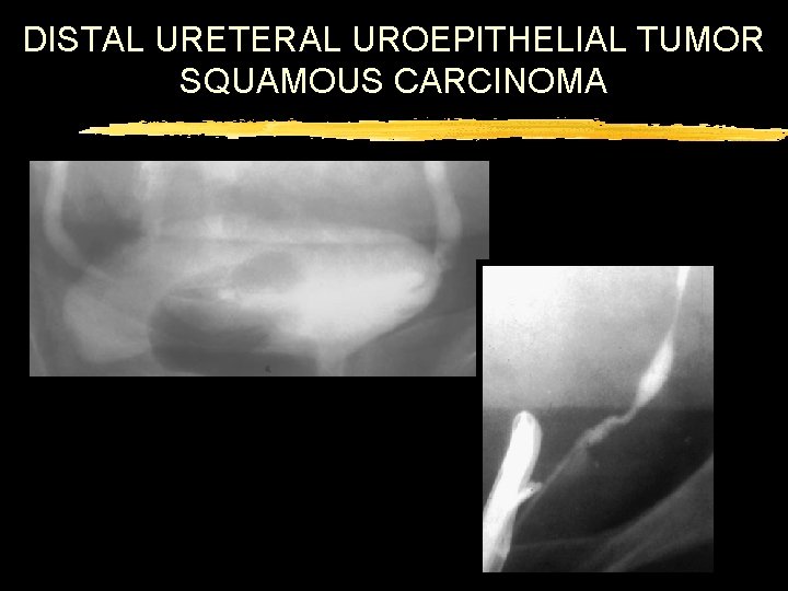 DISTAL URETERAL UROEPITHELIAL TUMOR SQUAMOUS CARCINOMA 