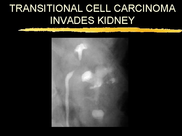 TRANSITIONAL CELL CARCINOMA INVADES KIDNEY 