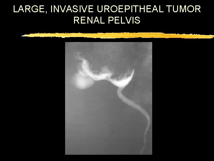 LARGE, INVASIVE UROEPITHEAL TUMOR RENAL PELVIS 