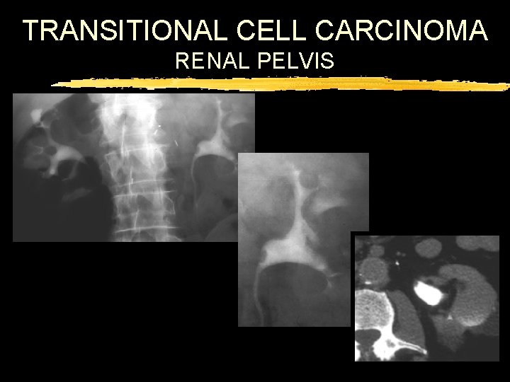 TRANSITIONAL CELL CARCINOMA RENAL PELVIS 