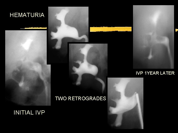 HEMATURIA IVP 1 YEAR LATER TWO RETROGRADES INITIAL IVP 