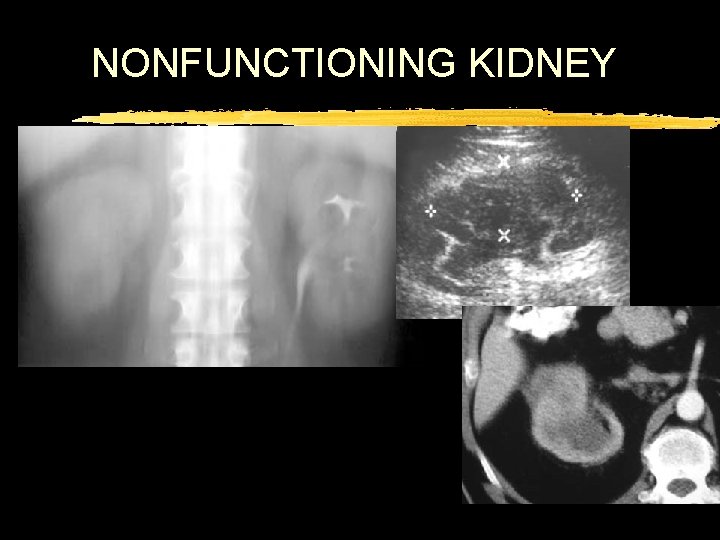 NONFUNCTIONING KIDNEY 