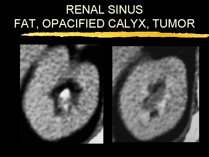 RENAL SINUS FAT, OPACIFIED CALYX, TUMOR 