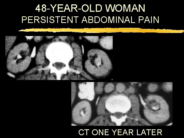 48 -YEAR-OLD WOMAN PERSISTENT ABDOMINAL PAIN CT ONE YEAR LATER 