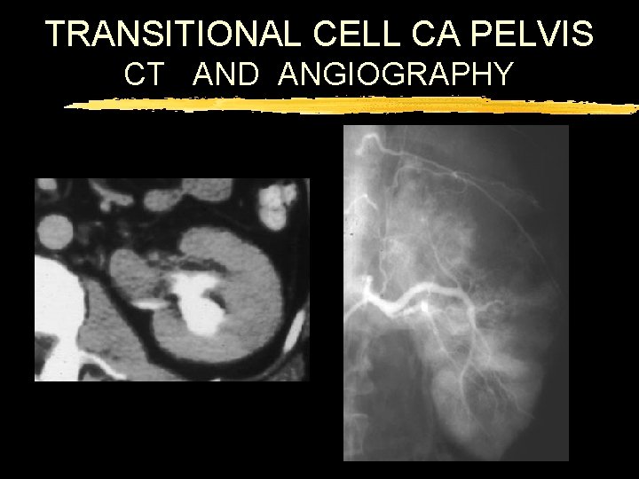 TRANSITIONAL CELL CA PELVIS CT AND ANGIOGRAPHY 
